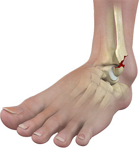 https://www.uhortho.com/3d-images/ankle-fractures.jpg