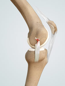 Dealing With & Treating Knee Pain from an MCL Injury